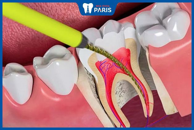 Điều trị tủy răng - bệnh viêm tủy răng có chữa được không