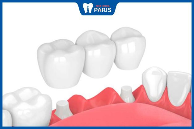 Cầu răng sứ được gắn trực tiếp lên cùi răng thật - các bước trồng răng giả