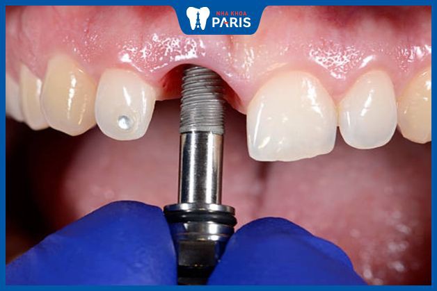 Trụ Implant được cắm trực tiếp vào vị trí mất răng