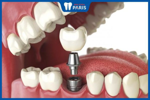Các bước trồng răng giả tại Nha khoa paris chuẩn pháp