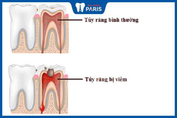 Các dấu hiệu viêm tủy răng, nguyên nhân và phương pháp điều trị