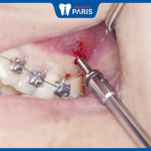 Chảy máu chân răng khi niềng: Nguyên nhân và cách hạn chế