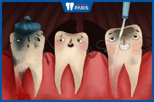 Có nên nhổ răng bị viêm tủy? Lưu ý cần biết sau khi thực hiện