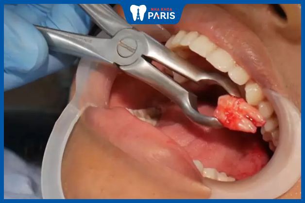 Bác sĩ khuyến cáo nên nhổ răng khôn mọc lệch càng sớm càng tốt - có nên nhổ răng khôn mọc lệch
