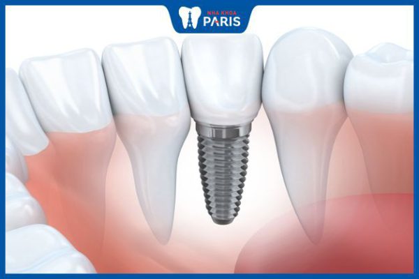 Độ tuổi trồng răng Implant, điều kiện trồng răng Implant cần biết