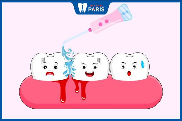 Chọn sai chế độ có thể gây chảy máu chân răng khi dùng tăm nước