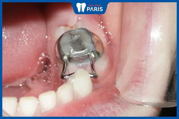 Giải pháp cho trẻ 15 tuổi nhổ răng hàm chưa trồng Implant được