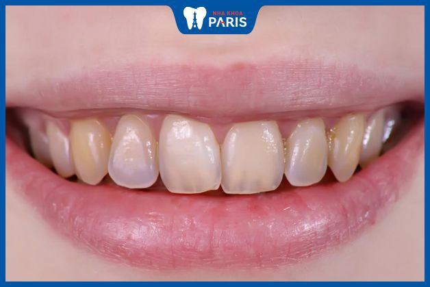 Nguyên nhân răng bị nhiễm màu thuốc kháng sinh