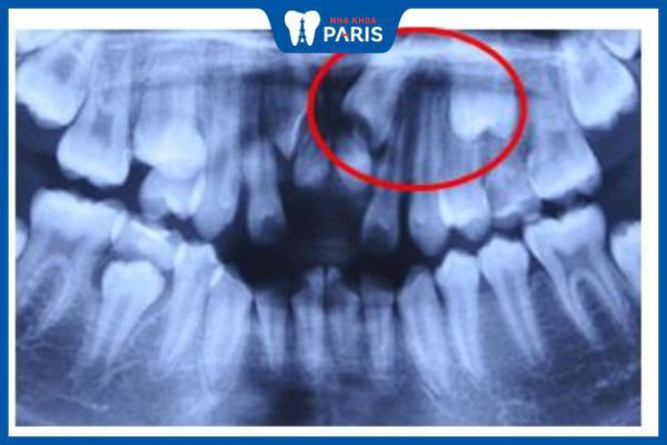 Nhổ răng cửa ngầm – Những thông tin quan trọng bạn cần biết