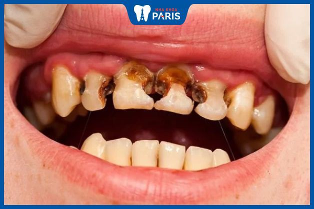 có nên nhổ răng hàm trên không - Nhổ răng hàm trên bị sâu nặng