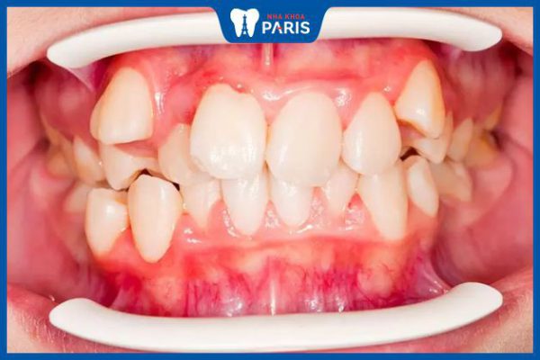 Niềng răng khểnh 2 bên mất bao lâu – 5 yếu tố ảnh hưởng