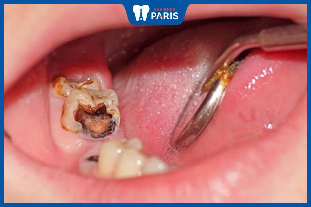 Trẻ bị sâu răng thường mất nhiều thời gian chỉnh nha hơn