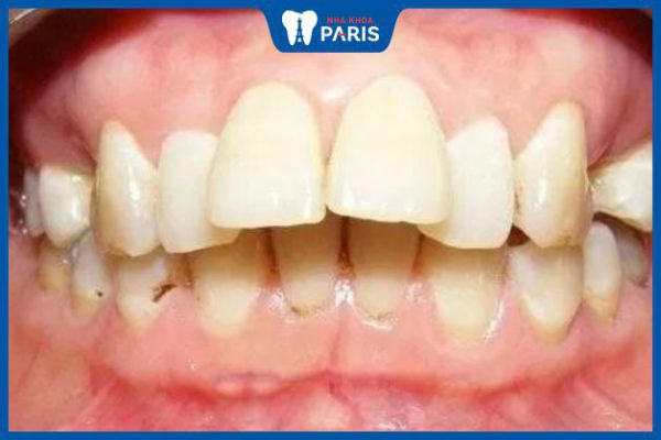 Răng bị hô ảnh hưởng như thế nào? Cách khắc phục hiệu quả