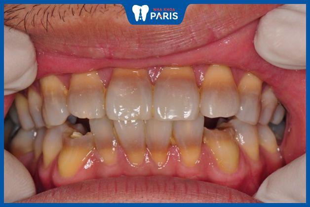 Răng bị nhiễm kháng sinh là gì