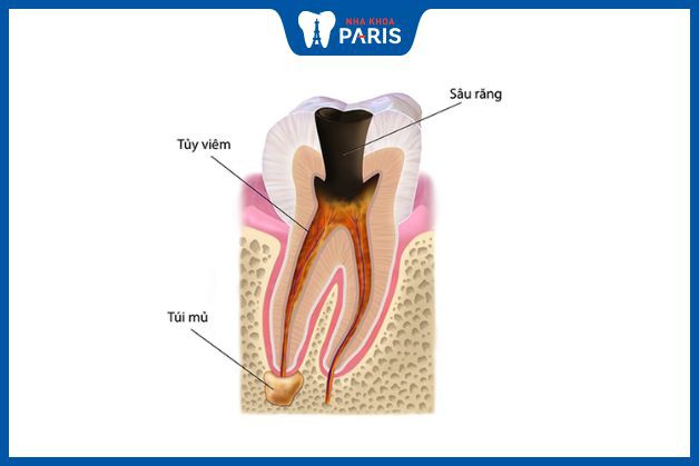 Răng bị viêm chết tủy tồn tại được bao lâu