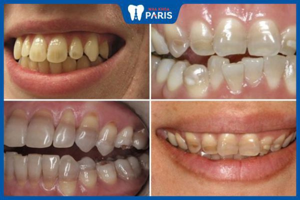 Răng bị xỉn màu kháng sinh: Dấu hiệu và phương pháp khắc phục