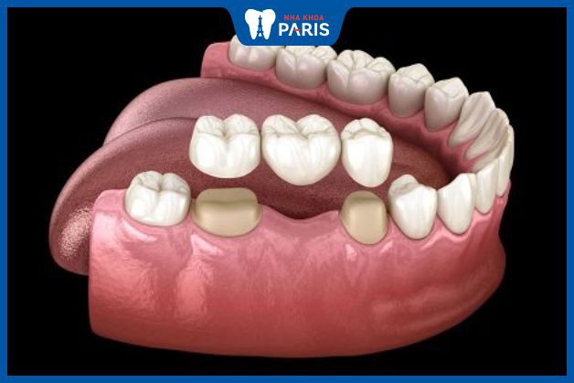 Răng hàm giả bằng phương pháp bắc cầu răng sứ