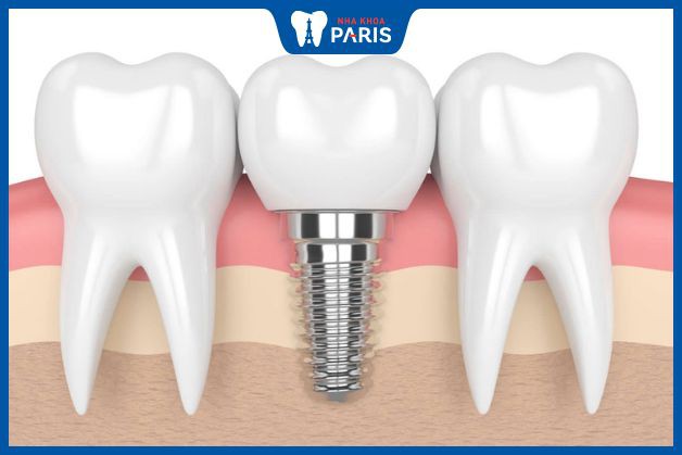 Răng hàm giả bằng phương pháp cấy ghép Implant