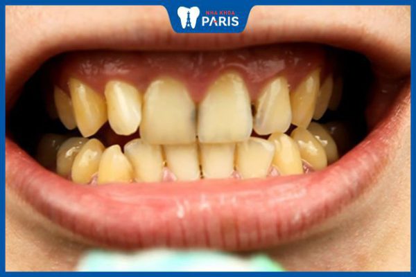 Răng ố vàng hôi miệng: Nguyên nhân, 6 cách điều trị tại nhà