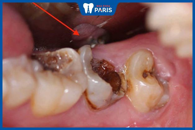 Răng sâu bị lung lay thường do vi khuẩn đã tấn công vào chân răng