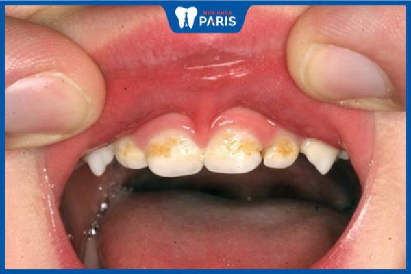Răng trẻ em bị xỉn màu: Nguyên nhân và cách khắc phục