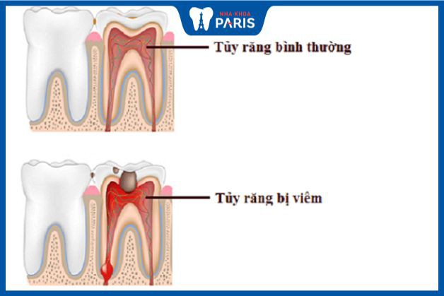 Tại sao có viêm tủy răng