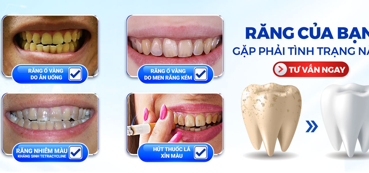 Nha Khoa Paris – Kiểm tra tình trạng răng ố vàng, nhiễm màu