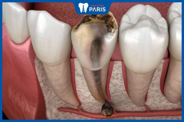 Viêm tủy răng bao lâu thì khỏi – 3 yếu tố tác động