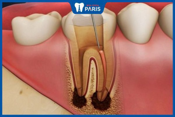 Viêm tủy răng có nguy hiểm không – Biện pháp điều trị hiệu quả