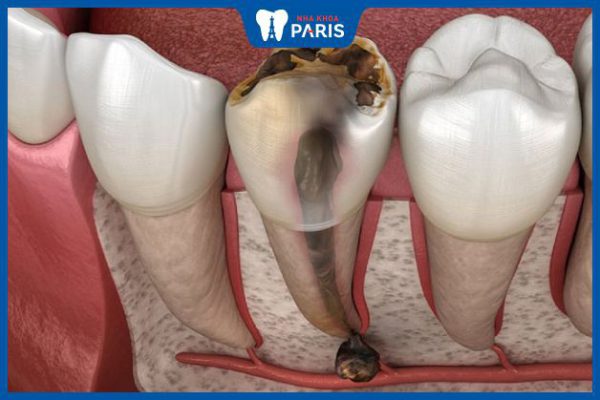Viêm tủy răng để lâu có sao không – 4 biến chứng nguy hiểm