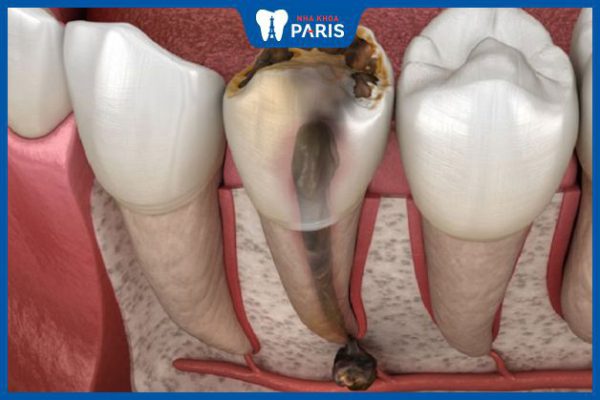 Viêm tủy răng hoại tử: Các biến chứng và phương pháp điều trị