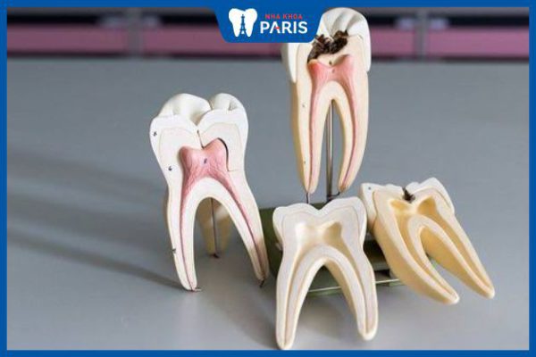 Viêm tủy răng mãn tính: Nguyên nhân, triệu chứng, cách điều trị