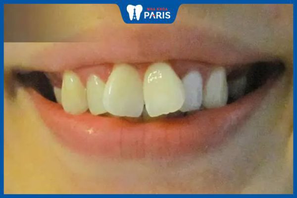 Bị hô răng 2 răng cửa: 2 giải pháp khắc phục và chi phí