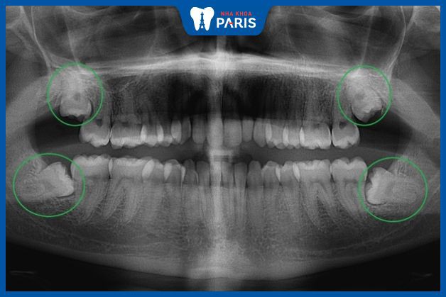 Khách hàng được chụp X-quang trước khi nhổ răng