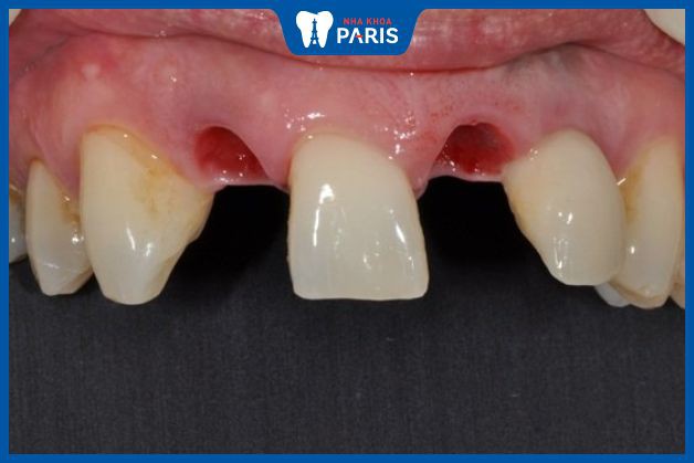 Cấy phép Implant phù hợp với trường hợp mất một hoặc nhiều răng