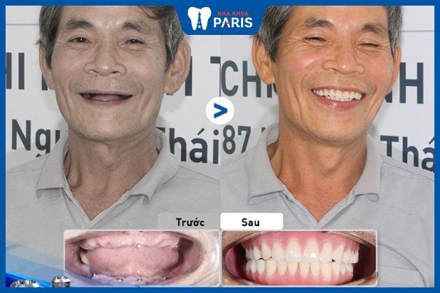 Trồng răng Implant All On đối với trường hợp mất toàn bộ răng ở cả 2 hàm và đã bị tiêu biến xương hàm