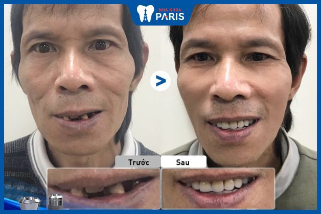 Trồng răng Implant 2 hàm cho khách hàng bị rụng nhiều răng hàm trên và dưới, khiến khuôn mặt hóp, mất thẩm mỹ, ăn nhai khó khăn