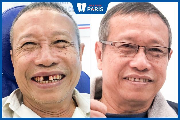 Cấy ghép Implant khôi phục 1 răng cửa bị mất