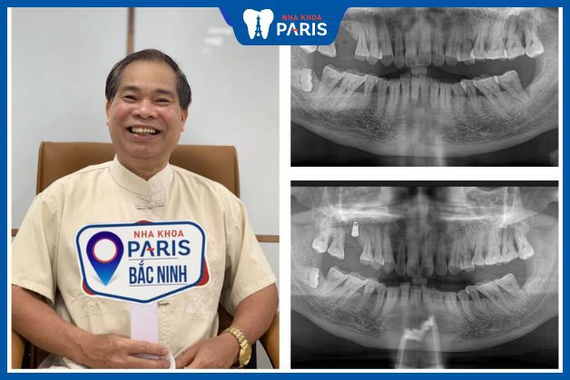 Trồng răng Implant cho khách hàng bị mất 1 răng ở hàm trên