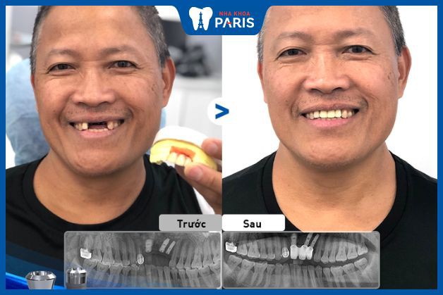 Cấy ghép răng Implant khôi phục 3 răng cửa bị mất