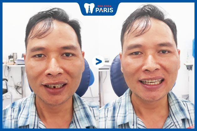  Khách hàng bị mất một răng cửa hàm dưới đã áp dụng kỹ thuật cấy ghép răng Implant để khôi phục chức năng ăn nhai của răng