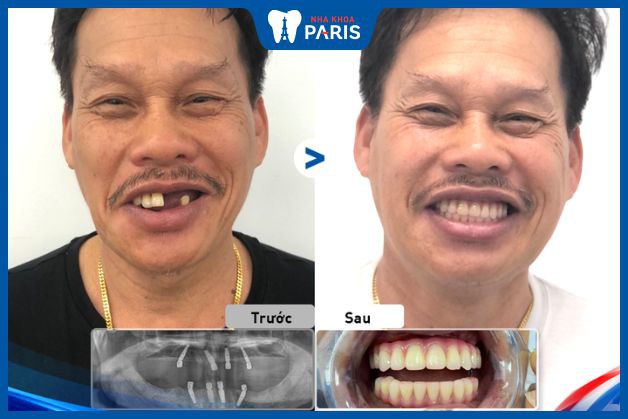 Cấy 4 trụ Implant ở cả 2 hàm đối với trường hợp mất nhiều răng 2 hàm, các răng còn lại lung lay và viêm nha chu nặng