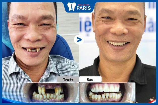Trồng răng Implant All On 4 cho khách hàng bị mất nhiều răng, hàm trên chỉ còn 5 răng không còn giá trị ăn nhai và nha chu hàm dưới nặng
