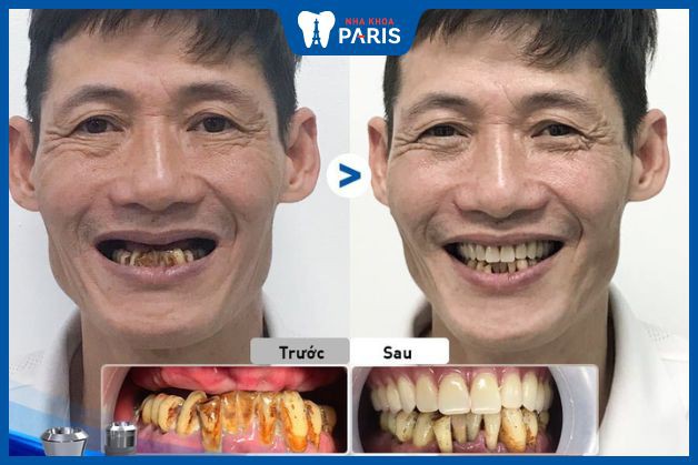 Hình ảnh trồng răng implant