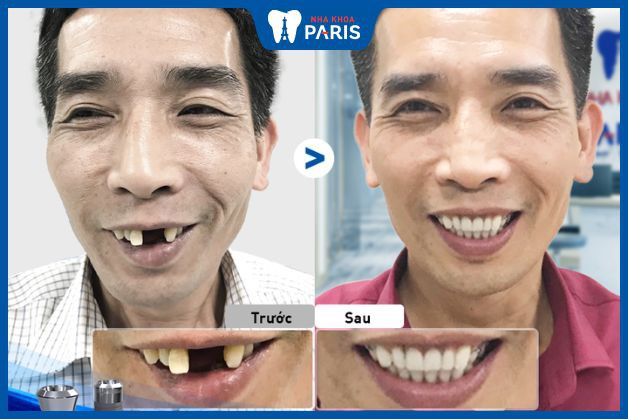 Trồng răng Implant cho trường hợp mất răng cả hai hàm và các răng xen kẽ nhau