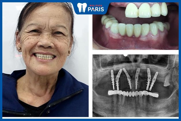 Trồng răng Implant đối với khách hàng bị mất nhiều răng ở hàm trên