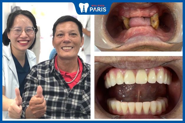 Cấy ghép răng Implant toàn hàm cho khách hàng bị mất toàn bộ răng ở cả hai hàm và mất khả năng ăn nhai
