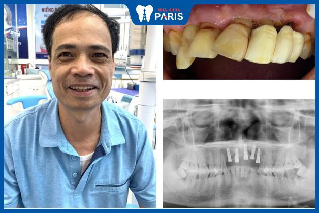Khách hàng cấy ghép 5 trụ Implant đối với trường hợp lung lay 5 răng cửa hàm trên và rất dễ rụng