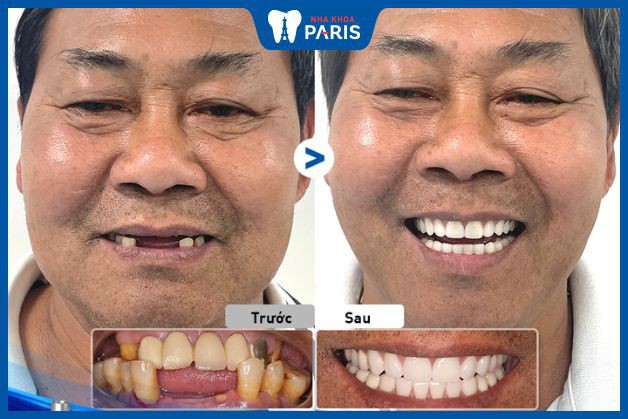 ồng răng All On hai hàm đối với trường hợp khách hàng bị mất nhiều răng, các răng còn lại bị viêm nha chu nghiêm trọng