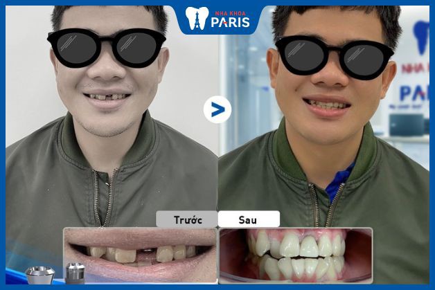 Khách hàng bị mất 1 răng cửa quyết định trồng răng Implant để đảm bảo tính thẩm mỹ của hàm răng